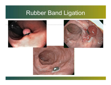 Rubber Band Ligation